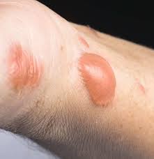 Do not reveal personally identifying information(pii), otherwise known as doxxing yourself. Burn Scars Treatment Removal And Prevention