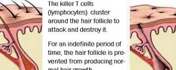 This will ensure even distribution of hair growth, and is important if you want to see results commonly associated with microneedling. Is Microneedling Effective For Alopecia Or Hair Loss What Are The Updates On Hair Loss Treatment Derma Roller Shop