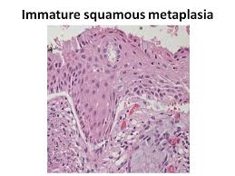 These changes don't signify a specific disease, but rather usually represent the body's response to stress or irritation. Normal Cervix Cervical Tz And How To Dissect A Lletz Ppt Video Online Download
