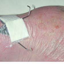 Dressing en pin massif.module penderie/3 étagères pin massif teinté hiba la redoute interieurs | la dressing pin massif have a graphic associated with the other. Pdf Antibiotics Vs An Antimicrobial Dressing For Pin Track Infection