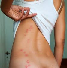 10 Usos Sorprendentes Que Le Puedes Dar A La Pomada De La Campana Mujer De 10 Pomada De La Campana Remedios Caseros Naturales Remedios Para Mosquitos
