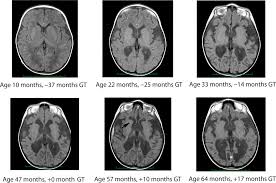 Long Term Follow Up After Gene Therapy For Canavan Disease Science Translational Medicine