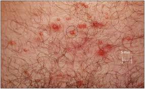 It is characterized by recurrent clusters of lesions in. Rapid Localized Spread And Immunologic Containment Define Herpes Simplex Virus 2 Reactivation In The Human Genital Tract Elife