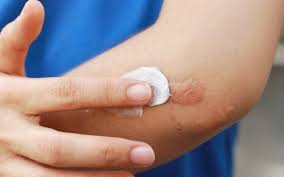 What Is Scar Revision Who Is A Candidate Scripps Health