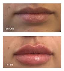 Hyapen pro™ needleless dermal fillers and fat dissolve natural results without the needles in fairfield, ct. Hyapen Infinity Beauty Massage