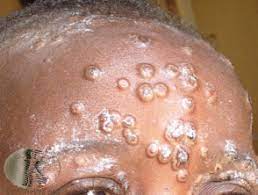 Is in the dumb group. Monkeypox Dermnet Nz