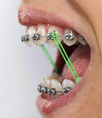 Aug 29, 2017 · here are some tips for adjusting to wearing rubber bands on your braces: Elastic Wear Protocol Northlake University Orthocare Orthodontics