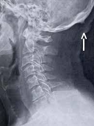 We did not find results for: Radiological Study Of Exostosis On The External Occipital Protuberance Download Scientific Diagram