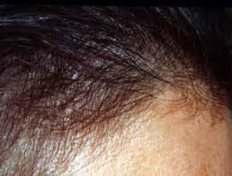 Scalp disorders may or may not be associated with hair loss. Disorders Of The Hair And Scalp Dermnet Nz