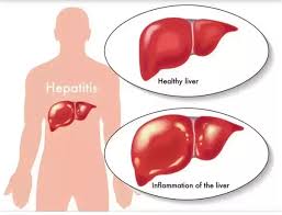 Other types of tests are also to be done to validate if the patient actually suffers from damage to the liver. Is High Sgpt Curable Quora