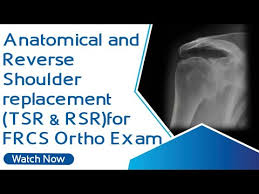 Shoulder arthroplasty • MEDtube.net