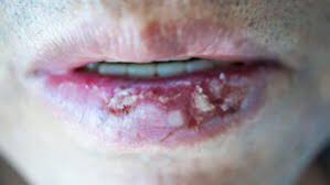 Image result for Lip Cancer