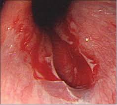 In a normal patient, this junction is protected by a flap that keeps out stomach acid, which can damage the junction. Risk Factors For An Iatrogenic Mallory Weiss Tear Requiring Bleeding Control During A Screening Upper Endoscopy