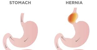 Hiatal hernias can occur for a number of reasons, including to identify a hiatal hernia, a health care provider may use multiple diagnostic techniques but will begin with a any instance in which the stomach or abdominal organs rotate or twist, causing severe pain, blockage. Hiatal Hernia Surgery Procedure Recovery And Outlook