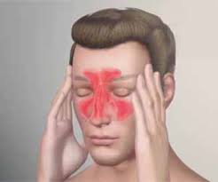 Chronic rhinosinusitis (crs) is a condition characterized by inflammation of the paranasal sinuses and lining of the nasal cavity for 12 weeks or more. Dupilumab May Benefit Patients Of Severe Chronic Rhinosinusitis With Nasal Polyps Lancet