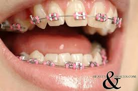 Pin By Isah On Braces Love Braces Colors Cute Braces Colors Dental Braces