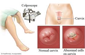 The amount of time you have to wait for results depends on where you live and where you had your pap done. Abnormal Pap And Colposcopy Northshore