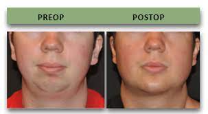 If properly placed silicone implants eroded bone just. World Renowned Bespoke Cosmetic Plastic Surgeon Boston Dr Michael Yaremchuk