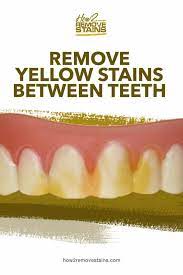 Jun 17, 2021 · one of the most basic and helpful ways to remove tooth stains from between your teeth is to practice good oral hygiene. How To Remove Yellow Stains Between Teeth Detailed Answer