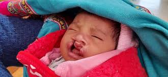 Los ninos del proyecto de fisura palatina