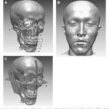 Figure 1 from Hard and soft tissue changes after correction of mandibular  prognathism and facial asymmetry by mandibular setback surgery:  three-dimensional analysis using computerized tomography.