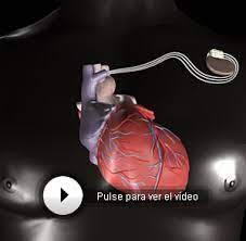 Um estudo mostrou que a implantação preventiva de um desfibrilador resultou em um declínio geral de 43% na mortalidade nos quatro anos resultantes. Enciclopedia De Tecnologia Medica Elmundo Es Salud