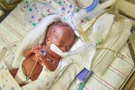 Image result for Preterm Infant