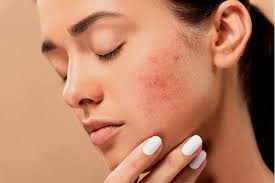 If treated with the right products, it can begin clear in as little as a few days with significant improvement in just a matter of weeks. Fungal Acne Fungal Acne Causes Treatments Prevention
