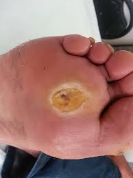 Maybe you would like to learn more about one of these? Venous Leg Ulceration Intechopen