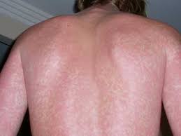 It occurs more frequently in the spring and affects primarily children and young adults. Maculopapuleuze Kinderziekten