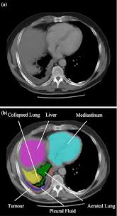 The standard time delay between administration of contrast and ct imaging acquisition is. Computer Aided Volumetric Assessment Of Malignant Pleural Mesothelioma On Ct Using A Random Walk Based Method Springerlink