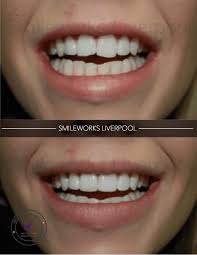 Veneers will add thickness to your patient's teeth. Composite Veneers Unbiased Professional Review For 2020