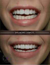 These rough spots usually from extra cement that can adhere to the veneer wear down after several days of normal eating and teeth brushing; Composite Veneers Unbiased Professional Review For 2020