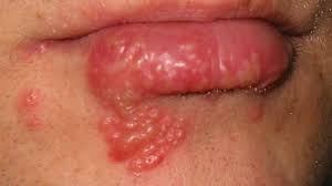 Vesicula auf der zunge loswerden! Akne Herpes Pickel Die Haufigsten Hauterkrankungen Im Gesicht