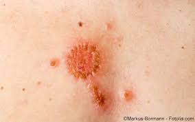 Basalzellkarzinom Symptome Diagnostik Therapie Gelbe Liste