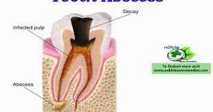 Best Natural Antibiotics Tooth Abscess Symptoms And Treatments Teeth Remedies Tooth Infection Abscess Tooth