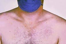 Dilansir dari nhs, demam tifoid atau tipes disebabkan oleh bakteri salmonella typhi. Demam Tifoid Wikipedia Bahasa Indonesia Ensiklopedia Bebas