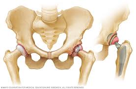A primer // the permanente journal. Osteoarthritis Diagnosis And Treatment Mayo Clinic