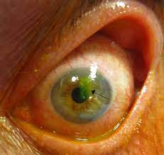 Corneal Abrasion - Wikipedia