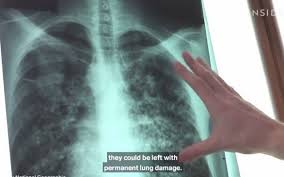 Medicul îți va prescrie un sirop de tuse, însă unele siropuri pot provoca multe efecte secundare și pot crea complicații. Video Ce Se IntamplÄƒ In Corpul TÄƒu DupÄƒ Infectarea Cu Coronaviurs EvoluÈ›ia Bolii Pe Zile