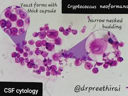 Cryptococcus neoformans is a fungus that lives in the environment throughout the world. Preethi Rai On Twitter Cryptococcus Neoformans In Csf Cytology Pathology Crittersontwitter Cytopath Found In Pigeon Droppings Cause Air Borne Infection Cause Bronchopneumonia Meningitis Usually Encapsulated Smaller Unencapsulated