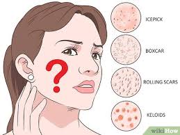 Sesetengah wanita cukup risau dengan parut di bahagian muka, u all boleh try petua ini.ambil kulit pisang emas.letakkan di bahgian parut.lakukan setiap hati sehingga parut anda hilang.try ler. 3 Cara Untuk Menghilangkan Parut Dan Luka Bekas Jerawat Wikihow