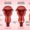 (some common signs of endometrial cancer may include: Https Encrypted Tbn0 Gstatic Com Images Q Tbn And9gcsezdofcfqj 0jqc6qm2ku2roenikdsyasuclzndse Usqp Cau