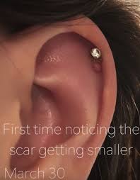 Bump On Cartilage Piercing Next To Jewelry Piercing Bump Stud Earrings Unique Cartilage Piercing