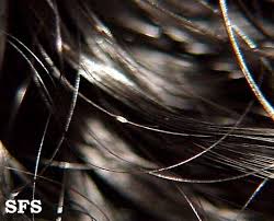 I was skeptical at first, but this is one of the only products i have found after extensive searching that specifically claims to treat white piedra. White Piedra Wikidoc