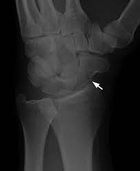 Maybe you would like to learn more about one of these? Wrist Radiology Key