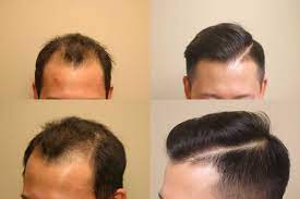 Hair Transplant Cilinic Near Me Delhi In 2021 Hair Transplant Hair Transplant Surgery Best Hair Transplant