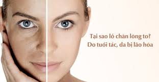 Tại Sao Lỗ Chân Lông To? Cách Khắc Phục Se Khít Lỗ Chân Lông