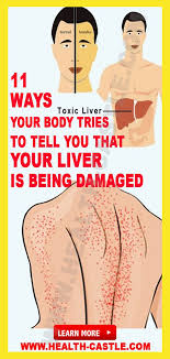 11 Ways Your Body Tries To Tell You That Your Liver Is Being Damagedthe Liver Is The Largest Solid Organ Natural Health Tips Health Tips Healthy Lifestyle Tips