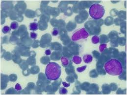 1, 2 erythroblasts are virtually absent in bone marrow; Frontiers Pure Red Cell Aplasia Prca And Cerebellar Hypoplasia As Atypical Features Of Polyglandular Autoimmune Syndrome Type I Aps 1 Two Sisters With The Same Aire Mutation But Different Phenotypes Pediatrics